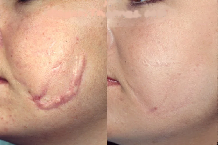 cicatrice+ipertrofica+2
